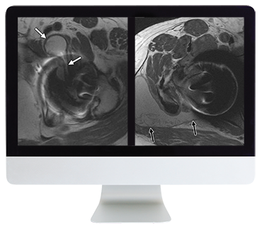 ARRS Controversies In Hip And Pelvis Imaging 2016